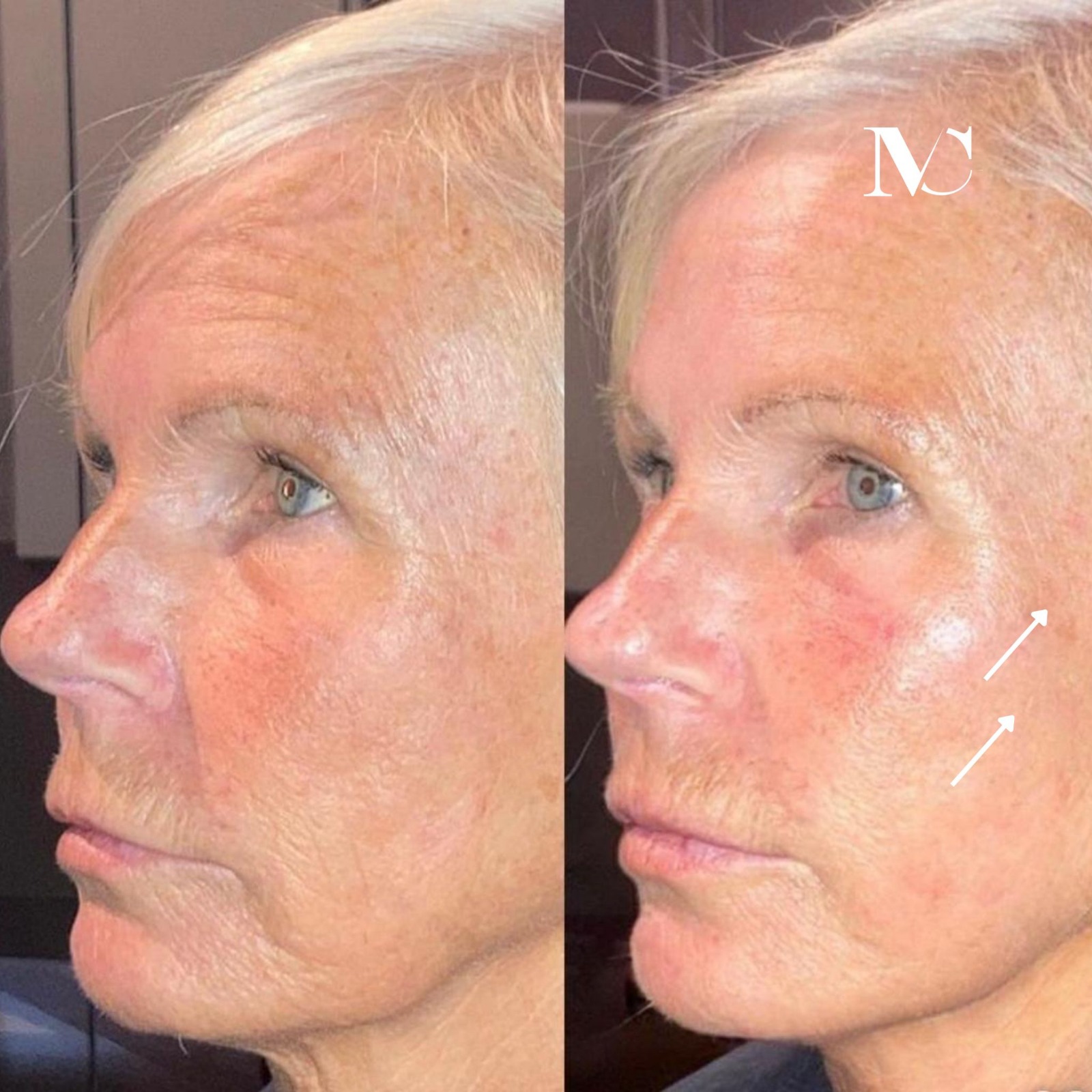 resultaat tca peeling resultaat tca peeling